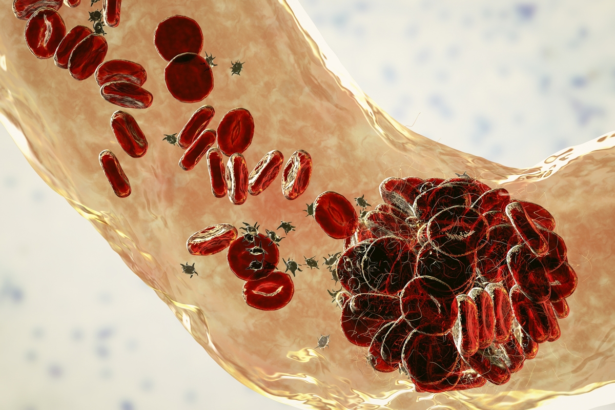 HPV: sangue menstrual pode ajudar a detectar câncer do colo do útero